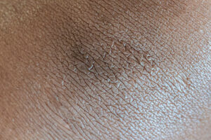 example dark patch of skin indicating Acanthosis Nigricans