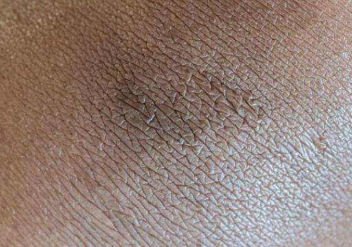 example dark patch of skin indicating Acanthosis Nigricans
